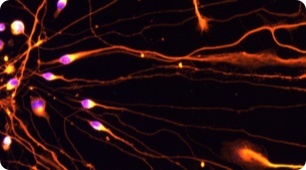Spinal Bulbar Muscular Atrophy<br> (SBMA)